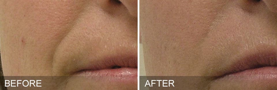 Hydrafacial-1-before-after