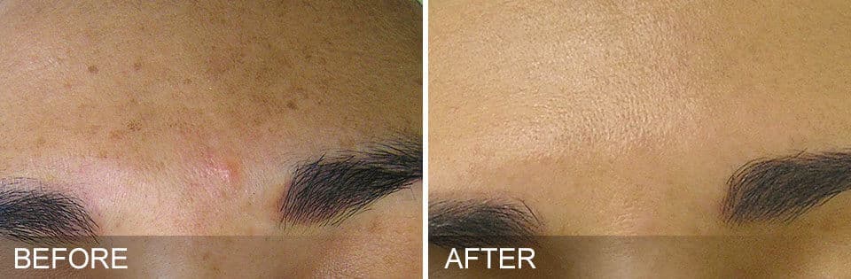 Hydrafacial-2-before-after