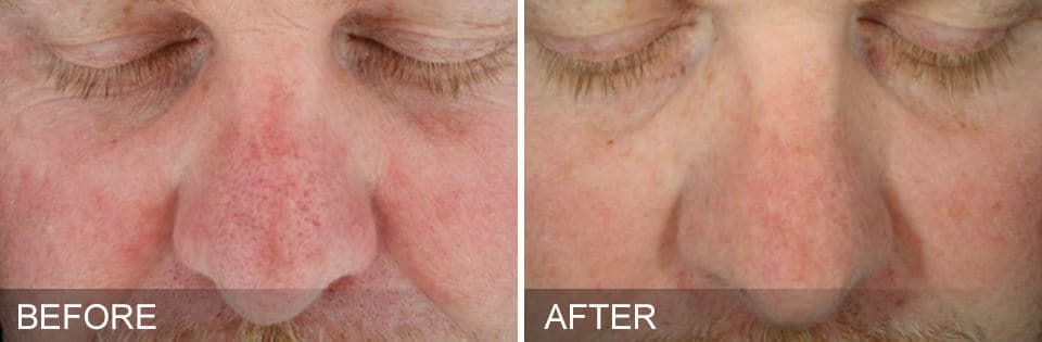 Hydrafacial-4-before-after