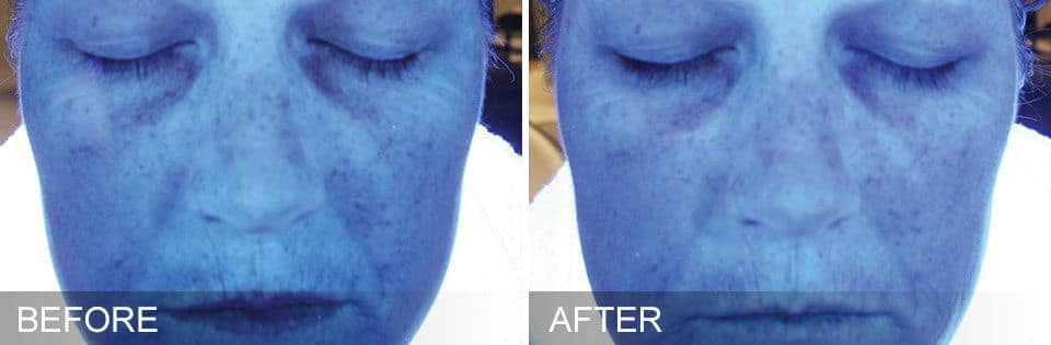 Hydrafacial-6-before-after