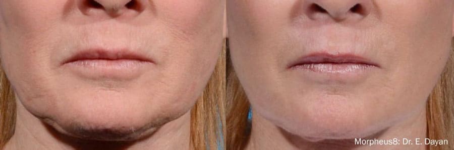 Hydrafacial-2-before-after