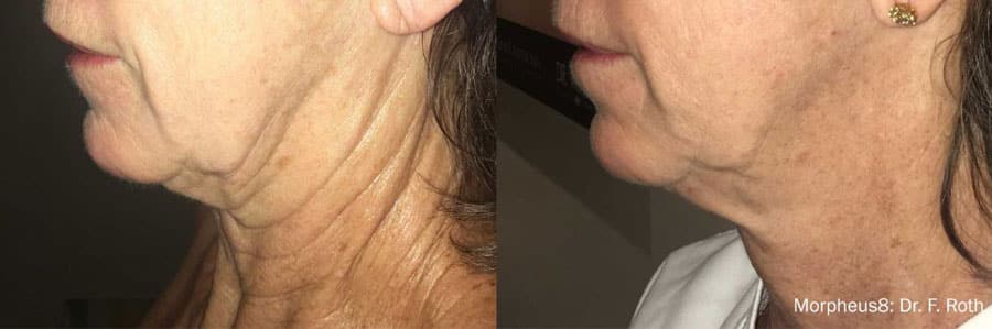 Hydrafacial-4-before-after