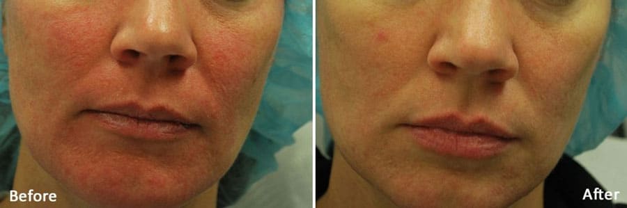 Hydrafacial-6-before-after