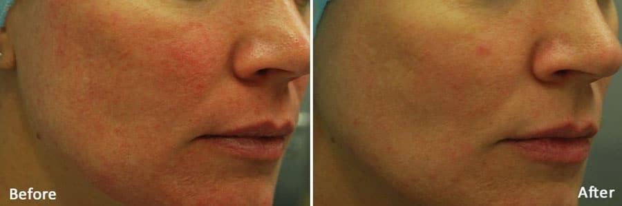 Hydrafacial-6-before-after