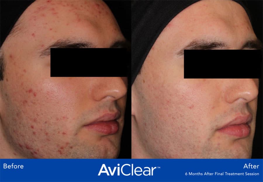 Acne Reduction before and after photo