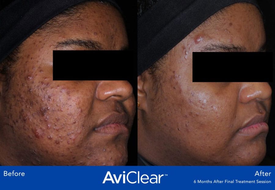 Acne Reduction before and after photo